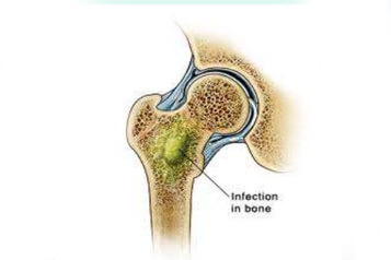 Bone and joint infections risk