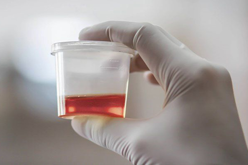 Retrograde Intrarenal Surgery