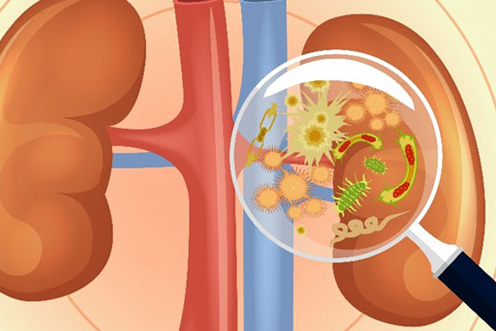Retrograde Intrarenal Surgery