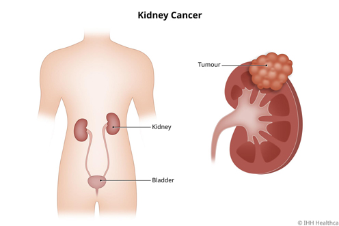 Retrograde Intrarenal Surgery
