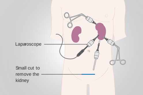 Retrograde Intrarenal Surgery