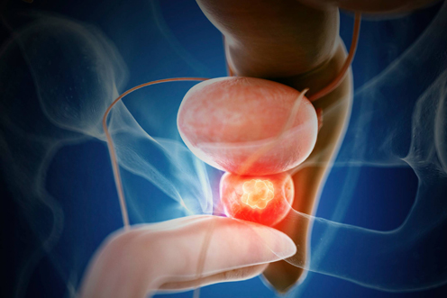 Retrograde Intrarenal Surgery