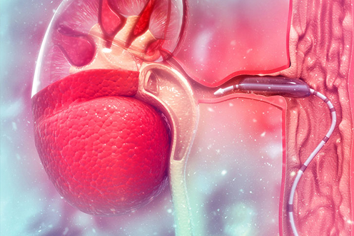 Retrograde Intrarenal Surgery