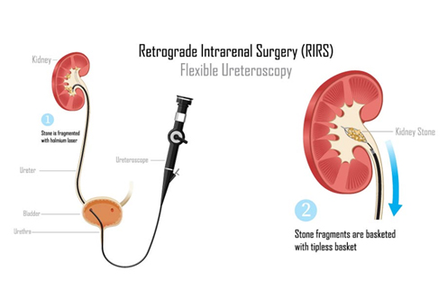 Retrograde Intrarenal Surgery