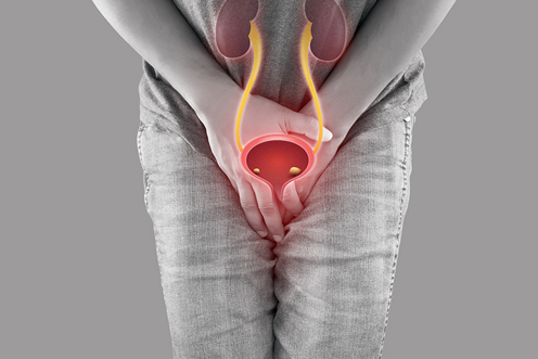 Retrograde Intrarenal Surgery